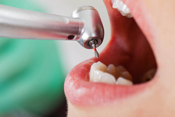 Best Emergency Dentist for Knocked-Out Tooth in Federalsburg, MD